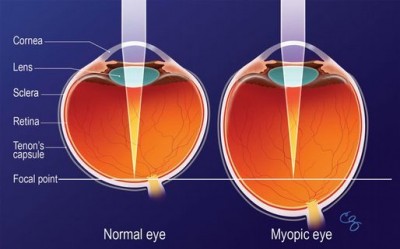 Táto dioptrická očná chyba spôsobuje zhoršené videnie do diaľky. Je to jedna z najčastejších očných chýb– diagnostikuje sa u viac než 30% ľudí a ich počet stále rastie.  Krátkozrakosť, odborne myopia, vzniká najčastejšie v detskom veku alebo v puberte, ale môže sa zistiť aj oveľa neskôr. Počas rastu dieťaťa sa chyba zhoršuje a medzi 20. – 25. rokom života sa v súvislosti s ukončením rastu zvyčajne ustáli a jej stupeň sa nemení. V niektorých prípadoch sa môže krátkozrakosť s pribúdajúcim vekom zhoršovať.