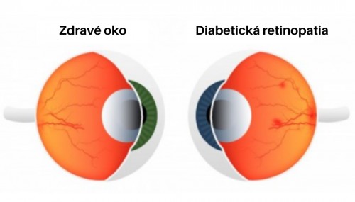 zdravé oko a oko s retinopatiou